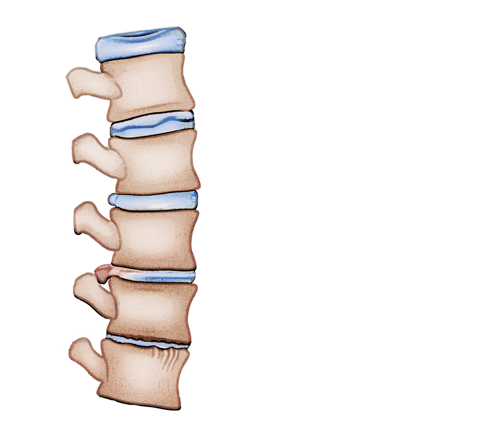 Will My Herniated Disc Heal On Its Own? - Neurosurgery & Spine