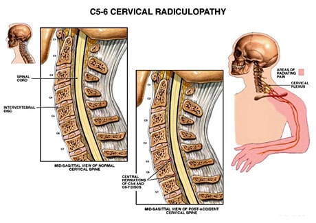 Pinched Nerve (Cervical Radiculopathy)