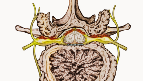 Is My Pain Caused By A Pinched Nerve Or A Herniated Disk?: Louisiana Pain  Specialists: Pain Management